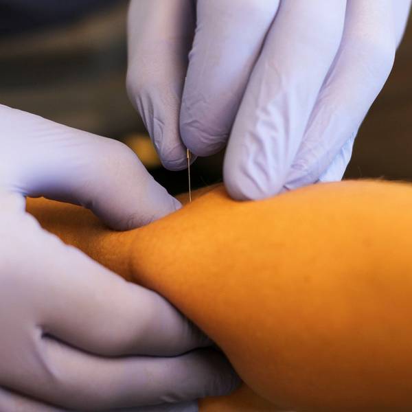 A close-up view of a medical professional performing acupuncture on a patient's knee, with both wearing gloves.