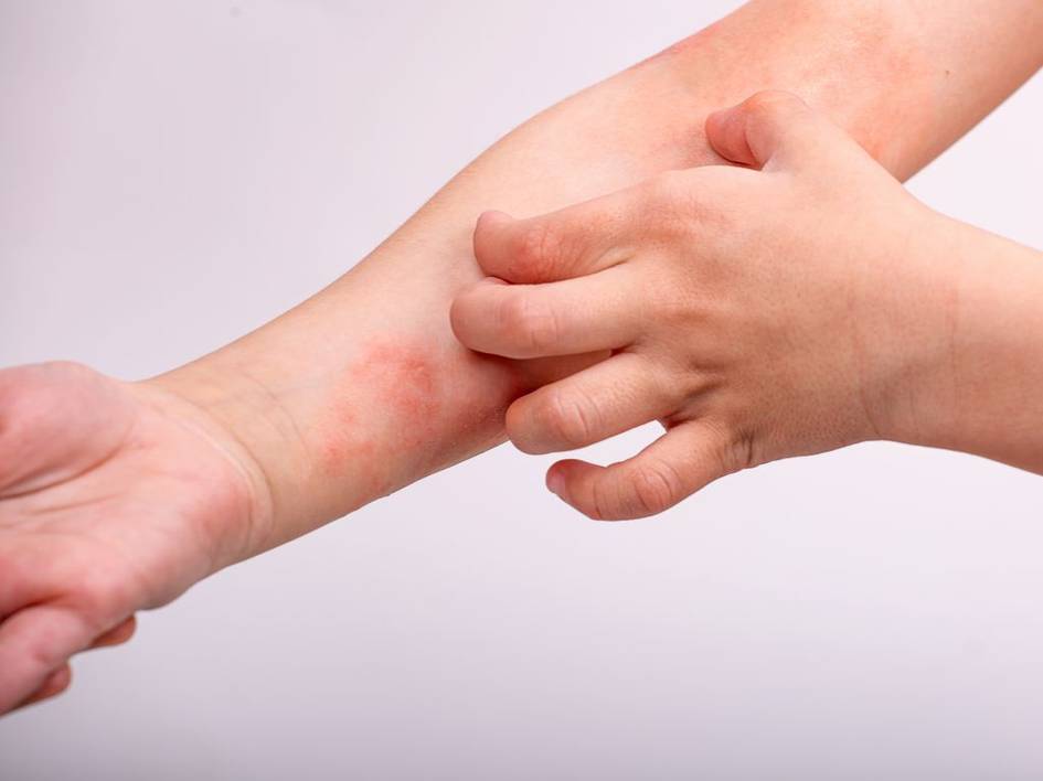 A close-up of two hands, one showing a patch of irritated skin, possibly an allergic reaction.